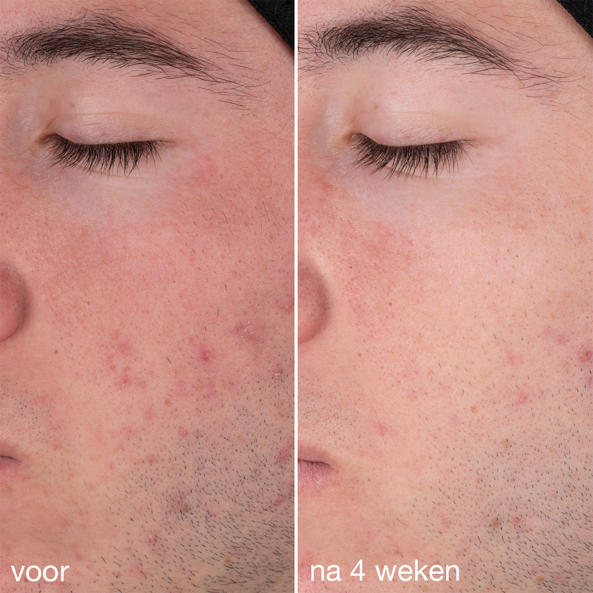 daily microfoliant before after