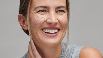 pigmentvlekken verminderen