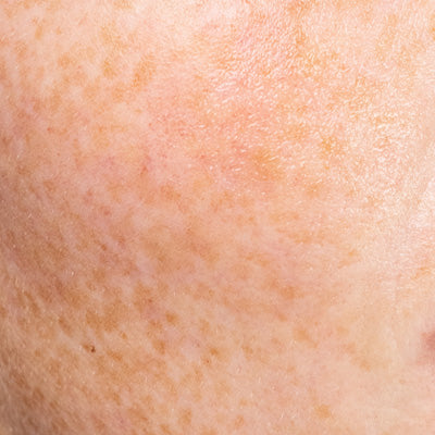 Gevoelige huid & Roodheid