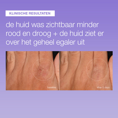 Voor en na 5 dagen Stabilizing Repair Serum: hand