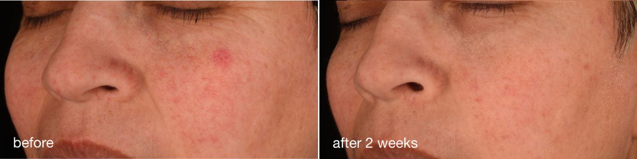 Pro-Collagen Banking Serum - before/after