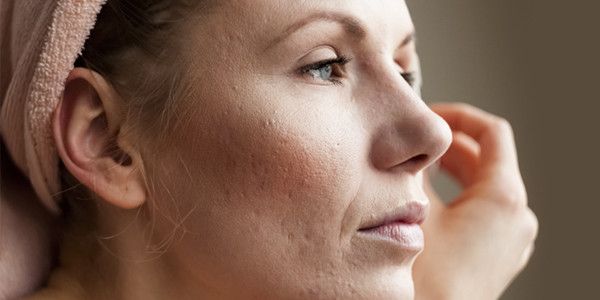 Hoe ontstaan onzuiverheden (acne) bij volwassenen?